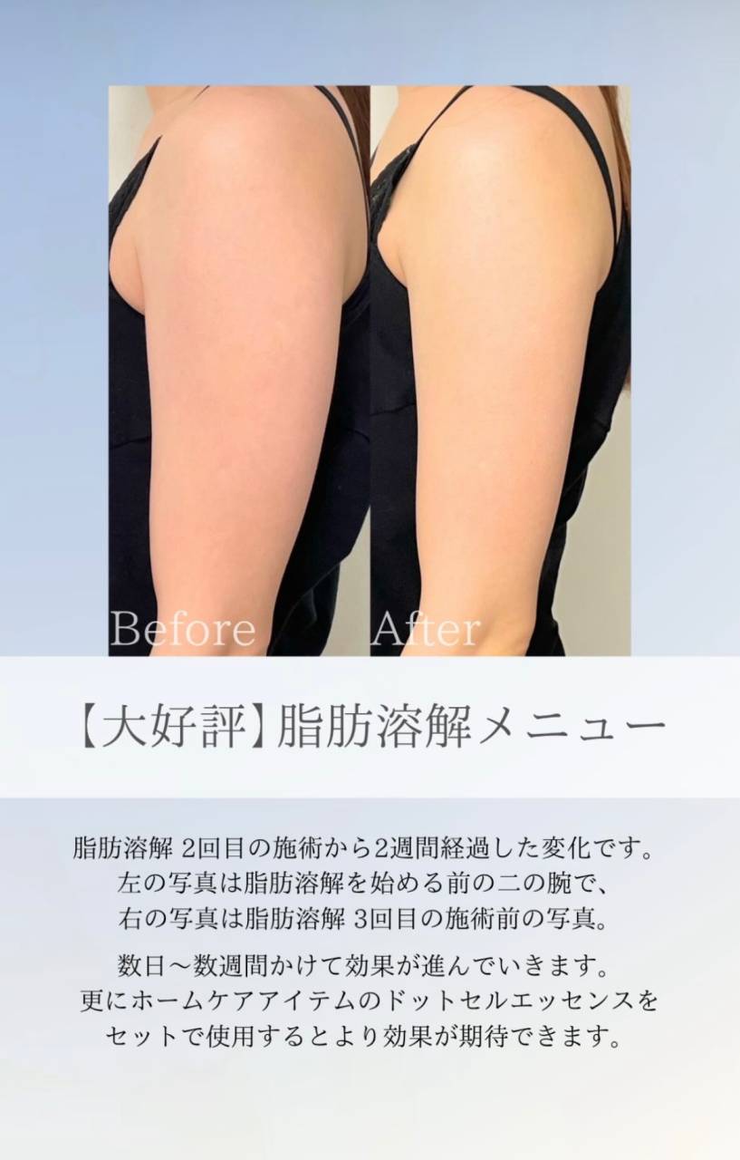 【HIFU】大人気商品！ドットルエッセンス♪