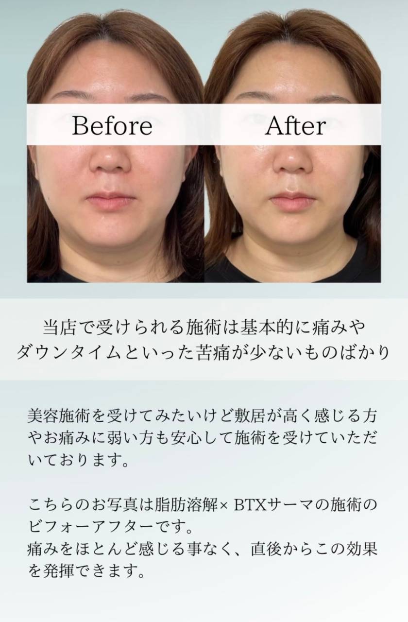 【HIFU】当院は安心して受けられる苦痛が少ない施術を行なっています♪