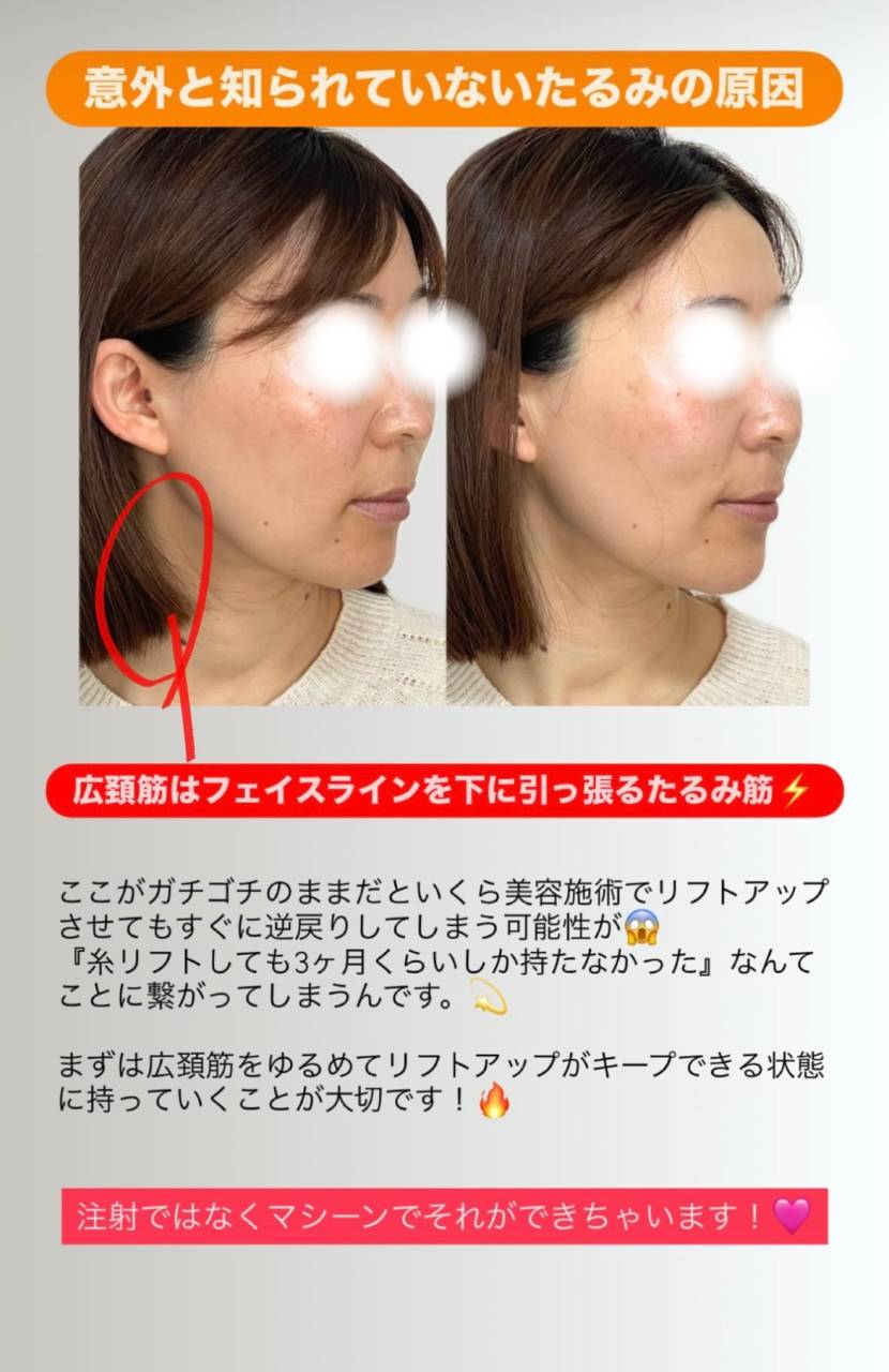 【HIFU】意外と知られていないたるみの原因とは！