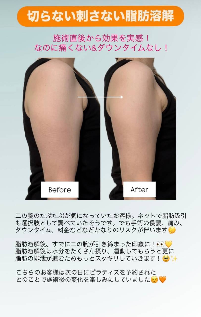 【HIFU】切らない刺さない脂肪溶解！