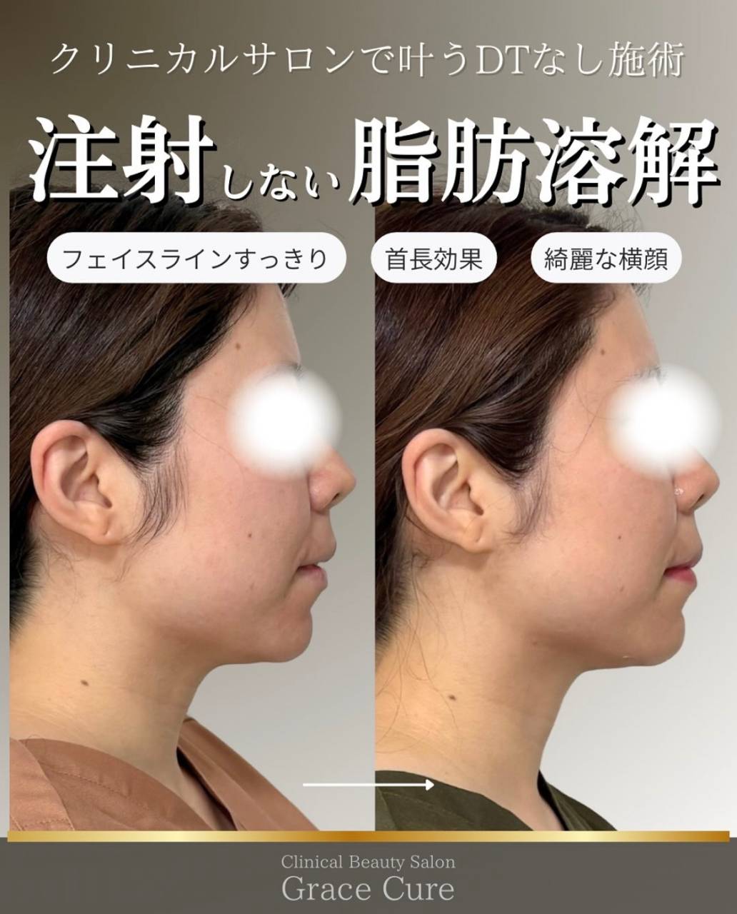 【HIFU】注射しない脂肪溶解を解説します！