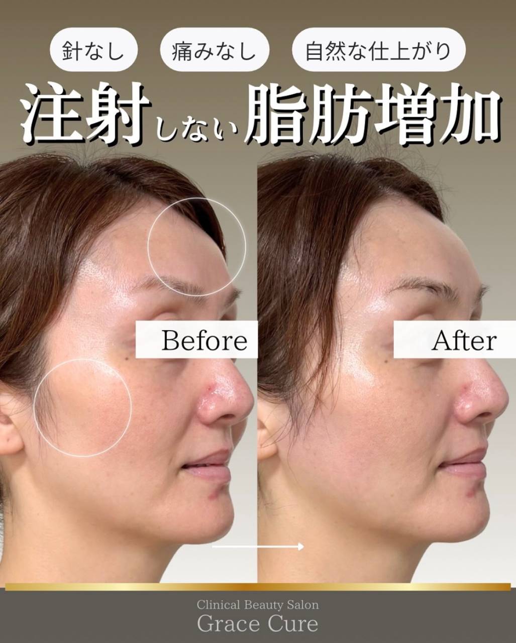 【HIFU】注射しない脂肪増加について解説♪